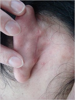 耳介軟骨採取部位の傷跡.jpg
